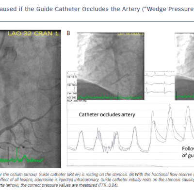 Figure 4 Errors Could be Caused if the Guide Catheter Occludes the Artery “Wedge Pressure” Due to a Stenosis Near&ampltbr /&ampgt&amp10the Ostium