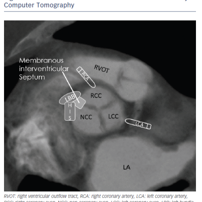 Figure 1 Short Axis View Reconstruction of Aortic Valve by Computer Tomography