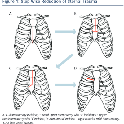 Know about Step Wise Reduction of Sternal Trauma