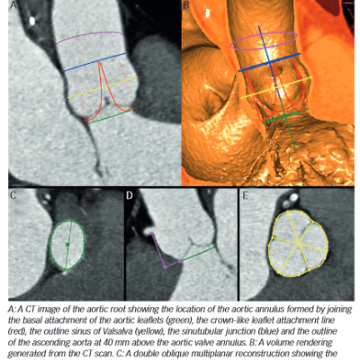 Image of Pre-Transcatheter Aortic Valve Replacement Analysis