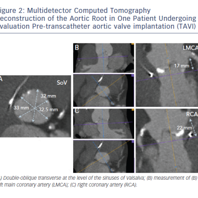 Figure 2 Multidetector Computed Tomography Reconstruction of the Aortic Root in One Patient Undergoing Evaluation Pre-transcatheter aortic valve implantation TAVI