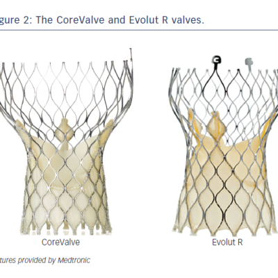 Figure 2 The CoreValve and Evolut R valves