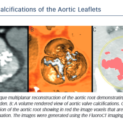 Figure of Calcifications of the Aortic Leaflets
