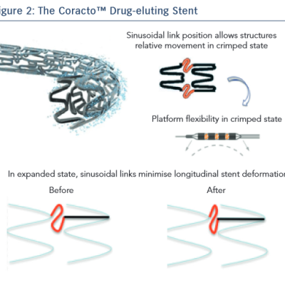 The Coracto Drug-eluting Stent