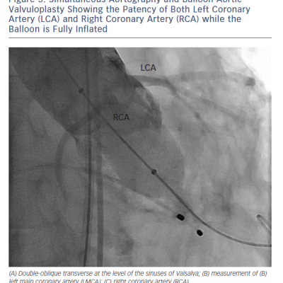 Figure 3 Simultaneous Aortography and Balloon Aortic Valvuloplasty Showing the Patency of Both Left Coronary Artery LCA and Right Coronary Artery RCA while the Balloon is Fully Inflated
