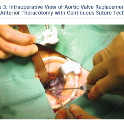 Image view of Aortic Valve Replacement Via Right Anterrior Thoracotomy