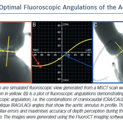 Optimal Fluoroscopic Angulations of the Aortic Root