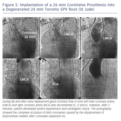Figure 5 Implantation of a 26-mm CoreValve Prosthesis into a Degenerated 24 mm Toronto SPV Root St Jude