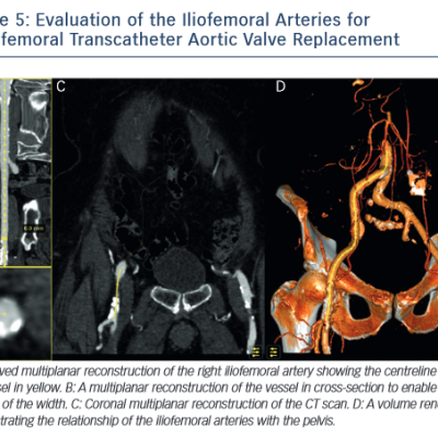 Evaluation of the lliofemoral Arteries for Transfermoral Transcatherter Aortic Valve Replacement