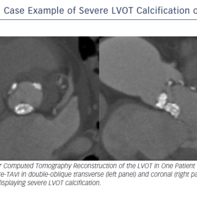 Figure 6 Case Example of Severe LVOT Calcification on MDCT