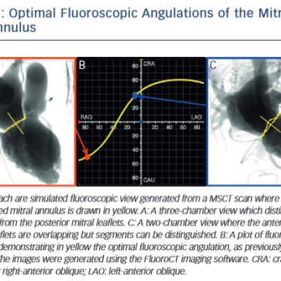 Optimal Fluoroscopic Angulations of the Mitral Valve Annulus