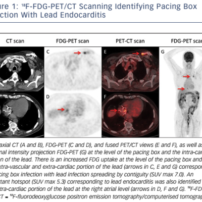 Figure 1 18F-FDG-PET/CT Scanning Identifying Pacing Box Infection With Lead Endocarditis