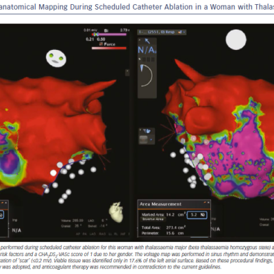 3D Electroanatomical Mapping During Scheduled Catheter Ablation in a Woman