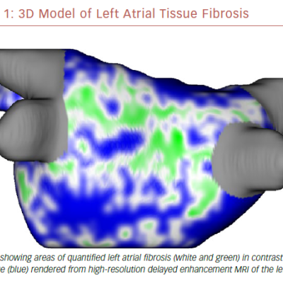 3D Model Of Left Atrial Tissue Fibrosis