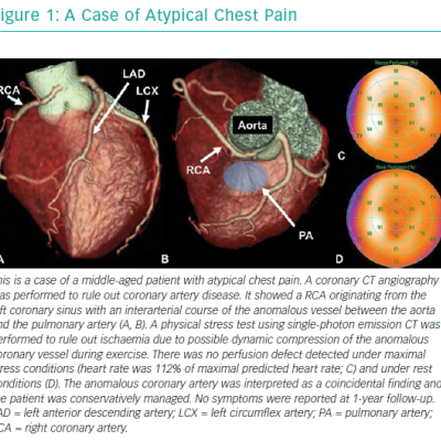 A Case Of Atypical Chest Pain