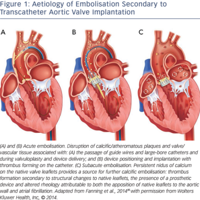 Figure 1 Aetiology of Embolisation Secondary to Transcatheter Aortic Valve Implantation