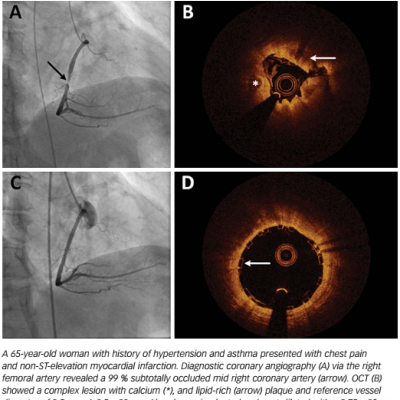 Figure 1 Angiography and OCT of BVS implanted in a subtotally occluded right coronary artery
