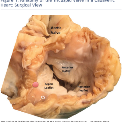 Figure 1 Anatomy of the Tricuspid Valve in a Cadaveric Heart Surgical View