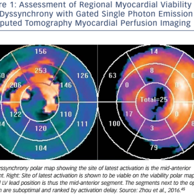 Figure 1 Assessment of Regional Myocardial Viability and Dyssynchrony with Gated Single Photon Emission Computed Tomography Myocardial Perfusion Imaging