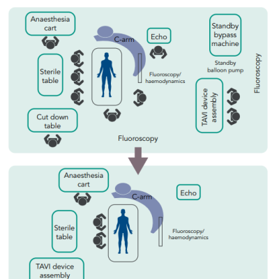 Before and After the Optimisation of Human Resources During Transfemoral TAVI