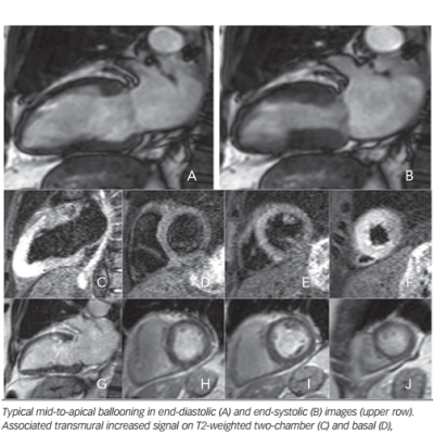 Figure 1 Cardiac Magnetic Resonance Exam of a 70-yearold Female Patient with Takotsubo Cardiomyopathy