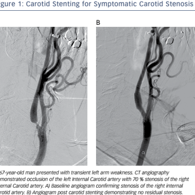 Figure 1 Carotid Stenting for Symptomatic Carotid Stenosis