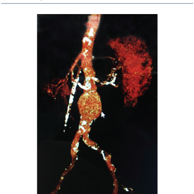 Figure 1 Computed Tomography Angiography&ampltbr /&ampgt&amp10Reconstruction of a 5.7-cm long Infrarenal Abdominal Aortic Aneurysm