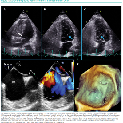 Echocardiographic Assessment of a Patent Foramen Ovale
