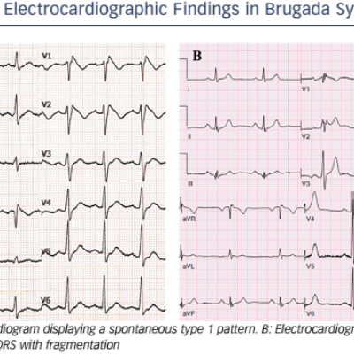 Electrocardiographic Findings in Brugada Syndrome