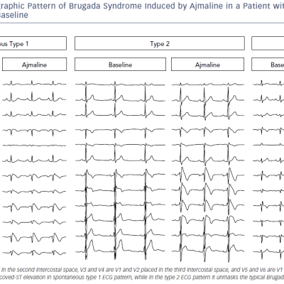 Electrocardiographic Pattern Of Brugada Syndrome