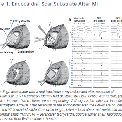 Endocardial Scar Substrate After MI