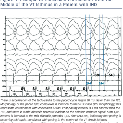 Example of Concealed Entrainment from the Middle of the VT Isthmus in a Patient with IHD