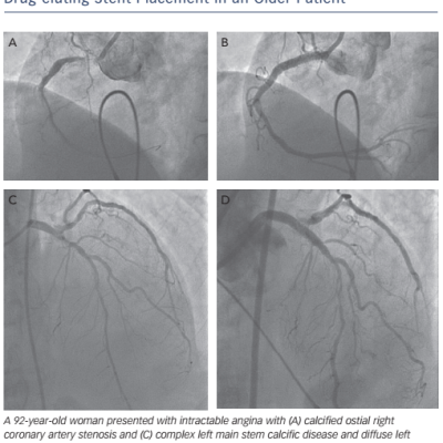 Figure 1 Example of Rotational Atherectomy Ballooning and Drug-eluting Stent Placement in an Older Patient