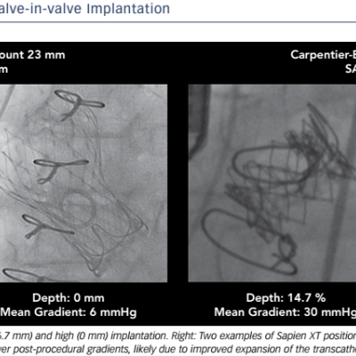 Figure 1 Examples of the Depth of Valve-in-valve Implantation