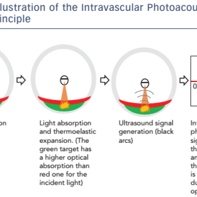 Figure 1 Illustration of the Intravascular Photoacoustic Imaging Principle