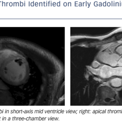 Figure 1 LV Thrombi Identified On Early Gadolinium-Enhanced Images