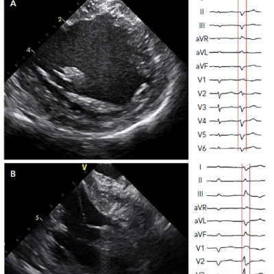 Left Ventricular Papillary Muscles As Visualised By Intracardiac Echocardiography