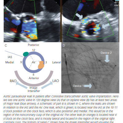 Figure 1 Location and Sizing of Aortic Paravalvular Leaks