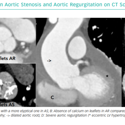 Main Differences Between Aortic Stenosis and Aortic Regurgitation on CT Scan