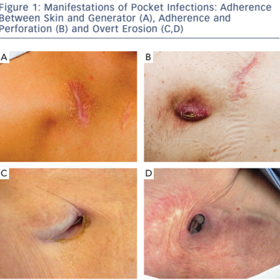 Figure 1 Manifestations of Pocket Infections Adherence Between Skin and Generator A Adherence and Perforation B and Overt Erosion CD