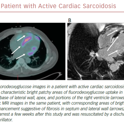 Patient With Active Cardiac Sarcoidosis
