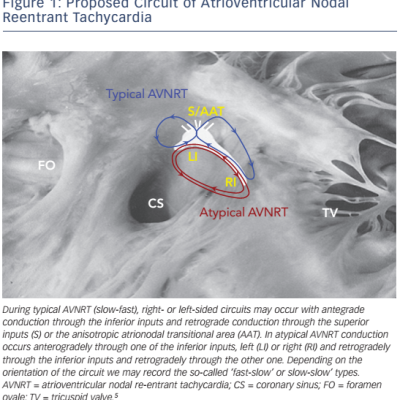 Figure 1 Proposed Circuit of Atrioventricular Nodal Reentrant Tachycardia