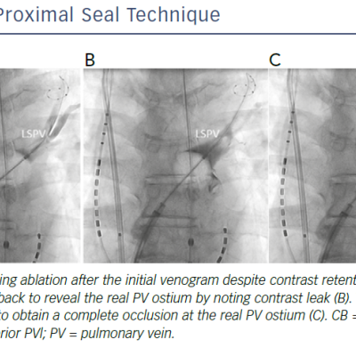 Proximal Seal Technique