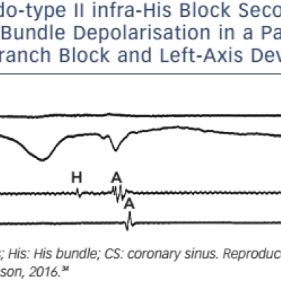 Figure 1 Pseudo-type II infra-His Block Secondary to a Concealed His Bundle Depolarisation in a Patient with Right Bundle Branch Block and Left-Axis Deviation