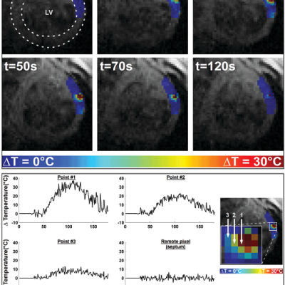 Figure 1 Real-time Temperature Mapping of LV Epicardial Ablation Lesion Using MR thermometry Relative Tissue Temperature Mapping