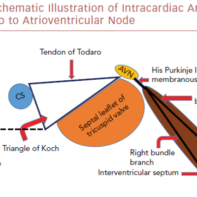 Schematic Illustration Of Intracardiac Anatomy