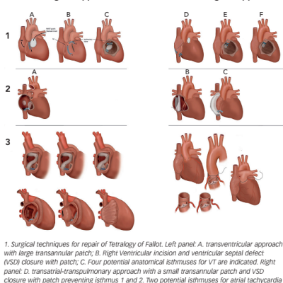 Figure 1 Schematic Overview Of Prior And Modern Surgical Approaches In Various Types Of Congenital Heart Disease And Resulting Anatomical Isthmuses For Tachyarrhythmias Blue Lines