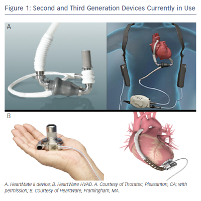 treatment with continuous-flow HeartMate II devices as DT was associated with improved survival compared to