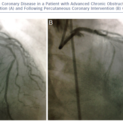 Severe Distal Left Main Coronary Disease In A Patient