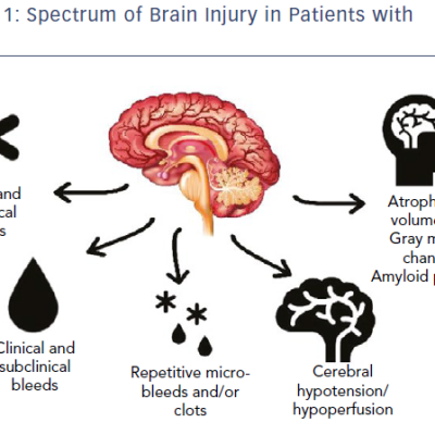 Spectrum Of Brain Injury In Patients With AF